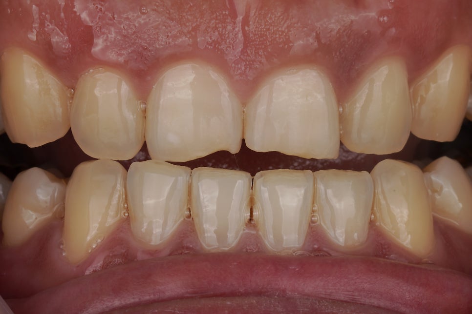 앞니 깨짐, 레진으로 1시간만에 감쪽같이 치료해드렸습니다. 관련 이미지 1