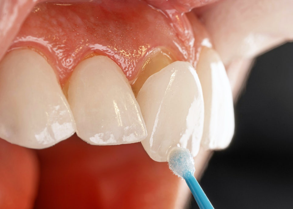 레진치료의 수명 라미네이트와 비교해 볼게요 관련 이미지 4