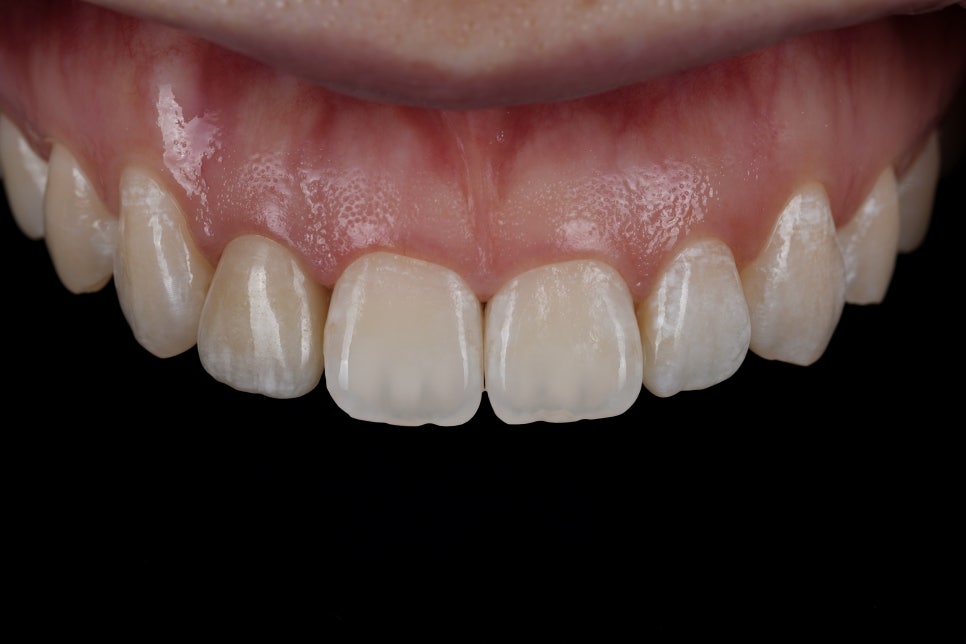 앞니 갈색 반점, 무삭제로 얼룩 제거 시술 : 아이콘 침투 관련 이미지 2