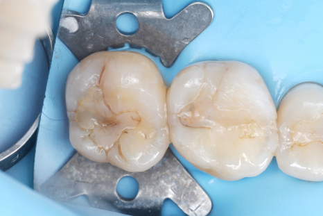 치과보존과 치아를 덜 깎는 치료를 지향하는 이유 관련 이미지 12