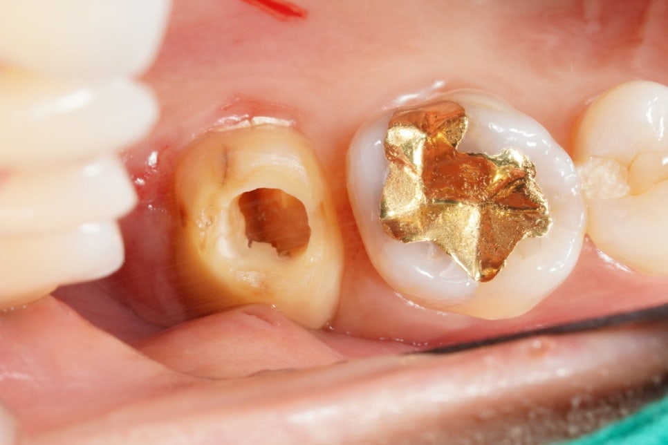 동기 치과의사의 부탁으로 어금니 신경치료만 마무리 해드린 케이스 관련 이미지 2