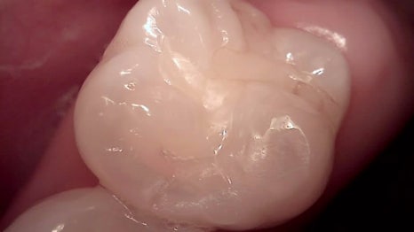 교대역 치과 보철 아래 2차 충치를 다시 레진으로 관련 이미지 11