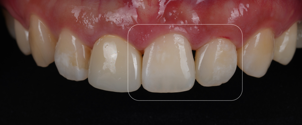 서초동치과 전라도 광주에서 레진 재치료 받으러 오신 사례 관련 이미지 10