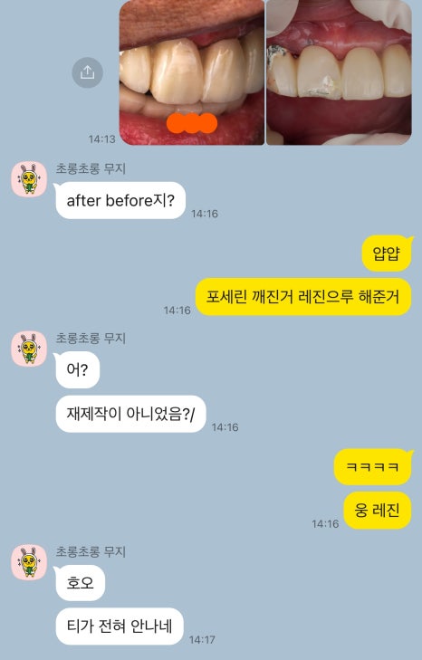 앞니 임플란트 PFM 보철 도자기 깨짐, 당일 수리해주는 서초 치과 관련 이미지 3