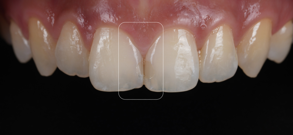 앞니사이충치 레진으로 치아성형 효과까지 낼 수 있어요 관련 이미지 2