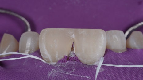 블랙트라이앵글 자연스럽게 메우는 비결은 이것 관련 이미지 10