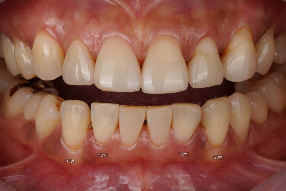 20년 전 때운 레진 떨어짐으로 이 사이 벌어짐 치료 : 교대역 치과에서 당일 레진 관련 이미지 1