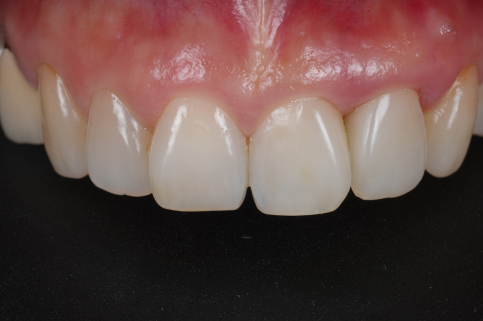 잘못된 앞니 레진 뼈까지 녹인다? 레진 재치료 과정 관련 이미지 16