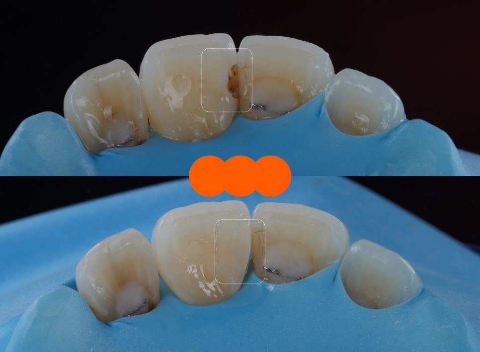 고속터미널역치과 레진치료 처음부터 잘 받아야 하는 이유 관련 이미지 11