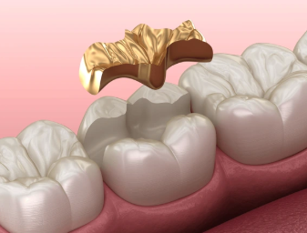 Gangnam Dental Clinic: You Wanted an Extraction, but We Preserved the Tooth with Root Canal Treatment + Overlay image 10