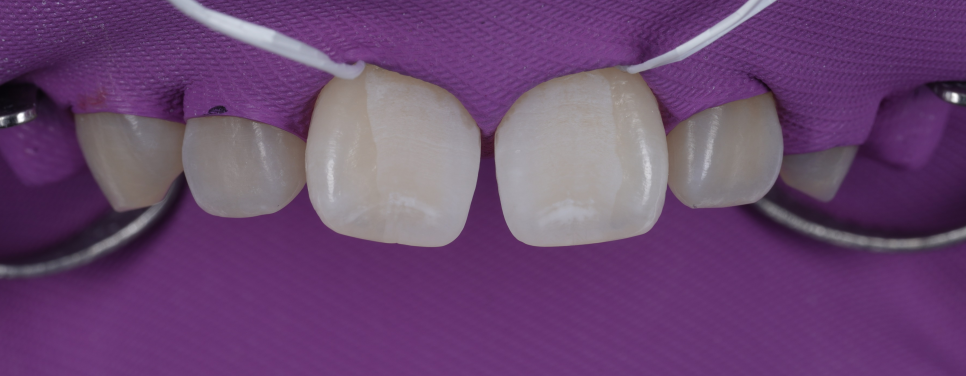 방배동치과 앞니 벌어짐 해결하러 강릉에서 오셨어요 관련 이미지 10