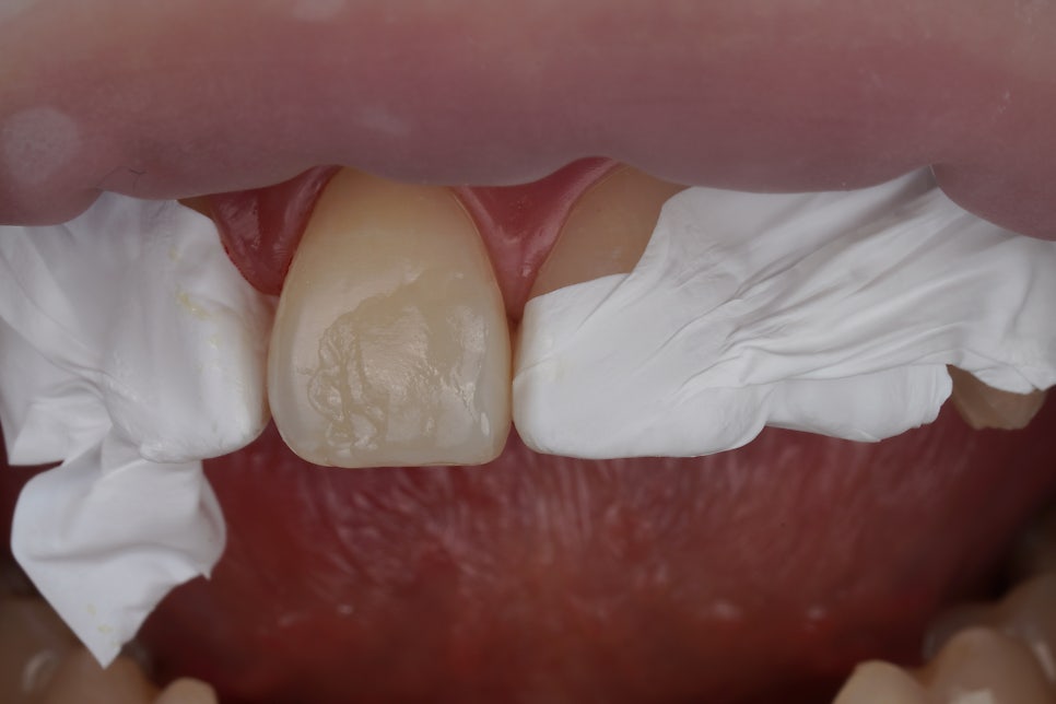 치과의사의 치아 살짝 깨짐, 레진으로 치료한 서초동 치과 관련 이미지 5