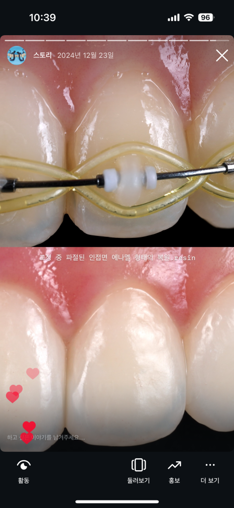 앞니 치료에 미쳐버린 치과의사 관련 이미지 2