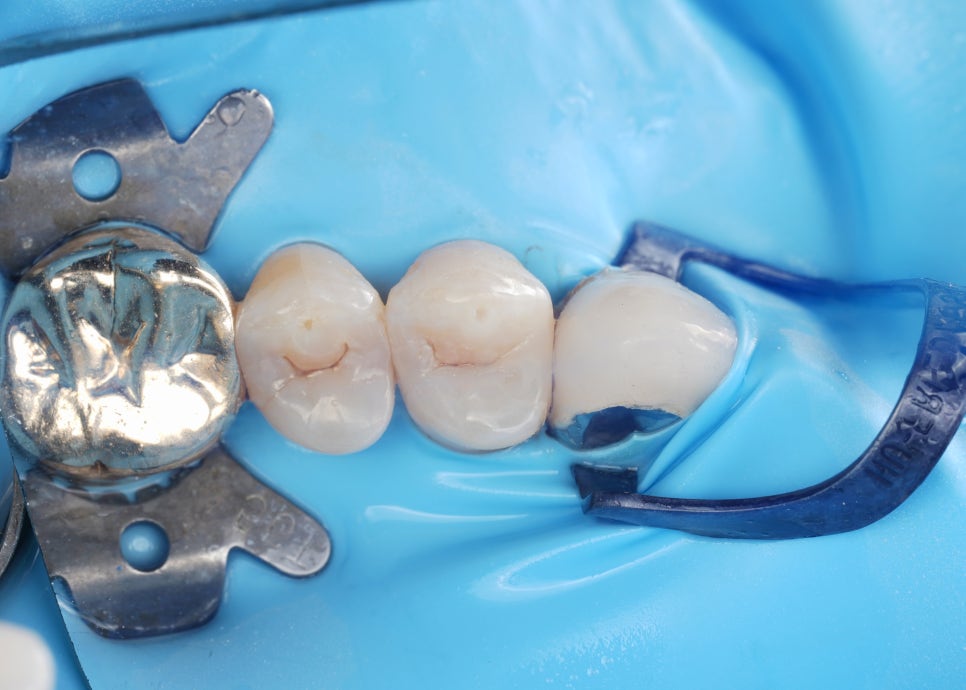 치아 사이 충치를 치료하는 방법, 레진과 인레이 비교 관련 이미지 4