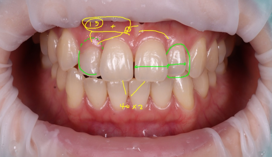 왜소치레진 20년 전에 했던 치아 재치료 후 반대쪽까지 관련 이미지 7