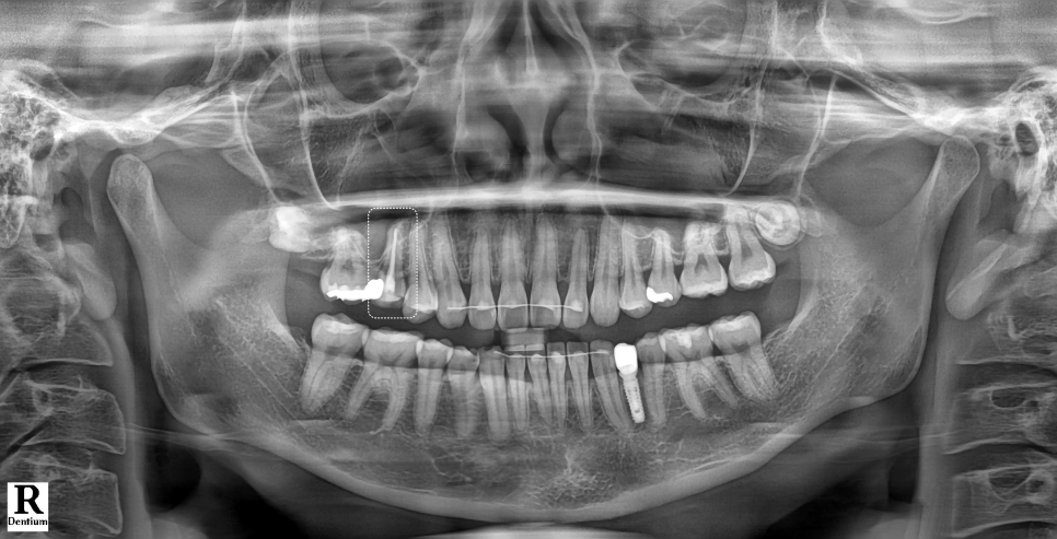 신경치료 후 크라운 안 하고 레진으로 할 수 있어요 관련 이미지 3