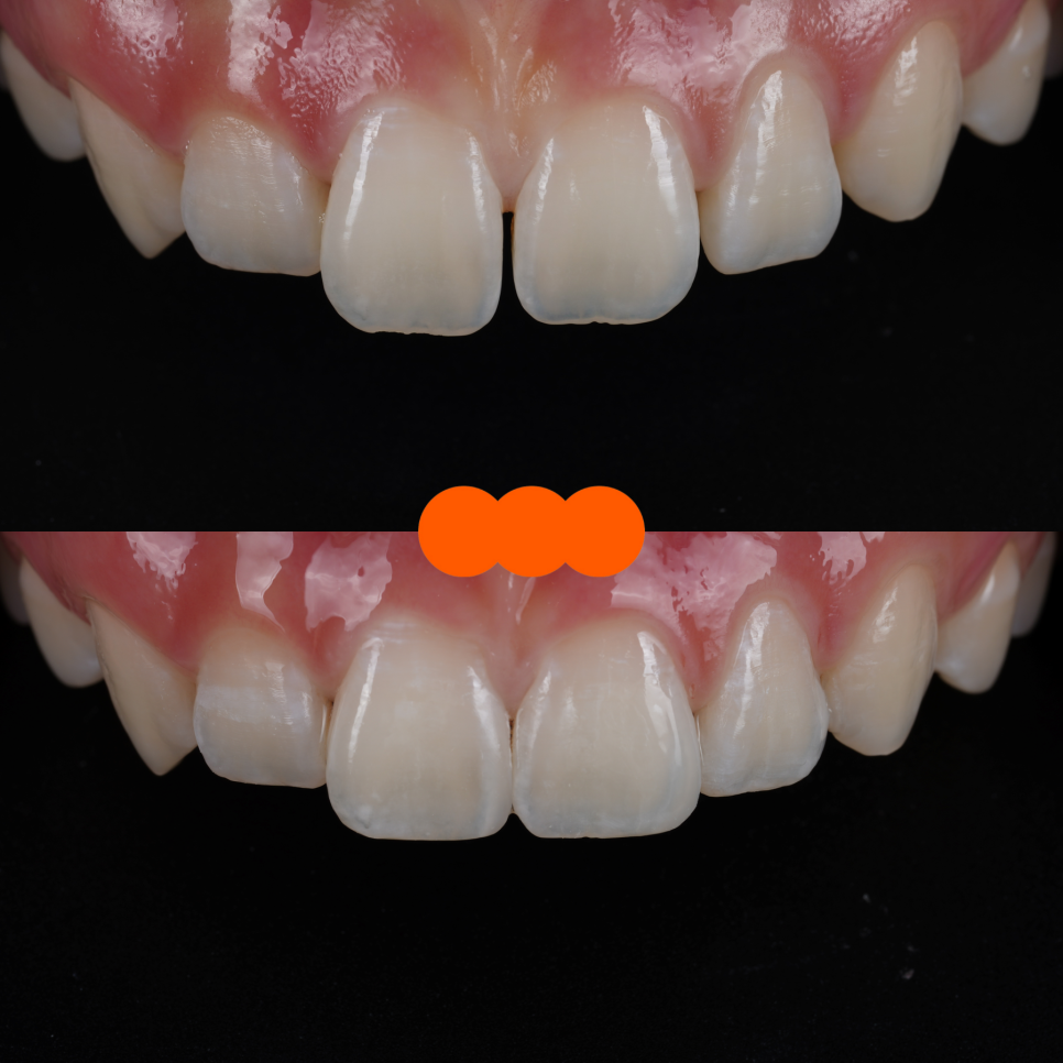 역삼역치과 벌어진 앞니 레진 이렇게 해야 진짜 티 안나요 관련 이미지 20