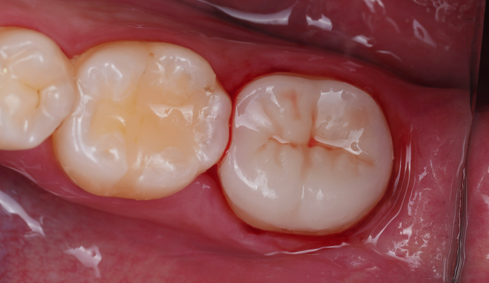 서초동치과 치아 삭제 원하지 않는다면 오버레이 하세요 관련 이미지 11