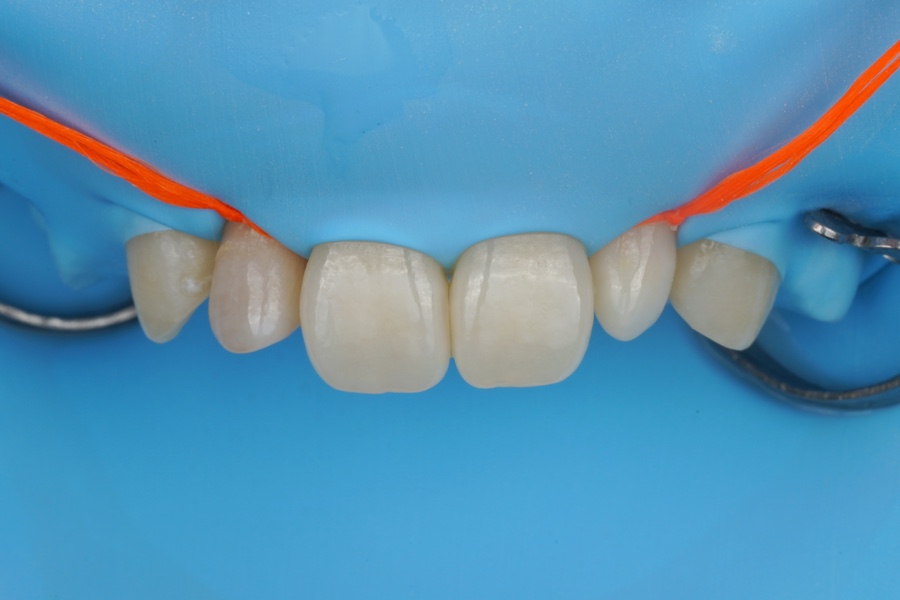 왜소치 레진 라미네이트, 당일 치료 완료! Direct composite veneer하는 서초동 치과 관련 이미지 3