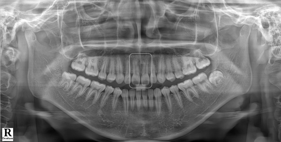 방배동치과 앞니 벌어짐 해결하러 강릉에서 오셨어요 관련 이미지 3