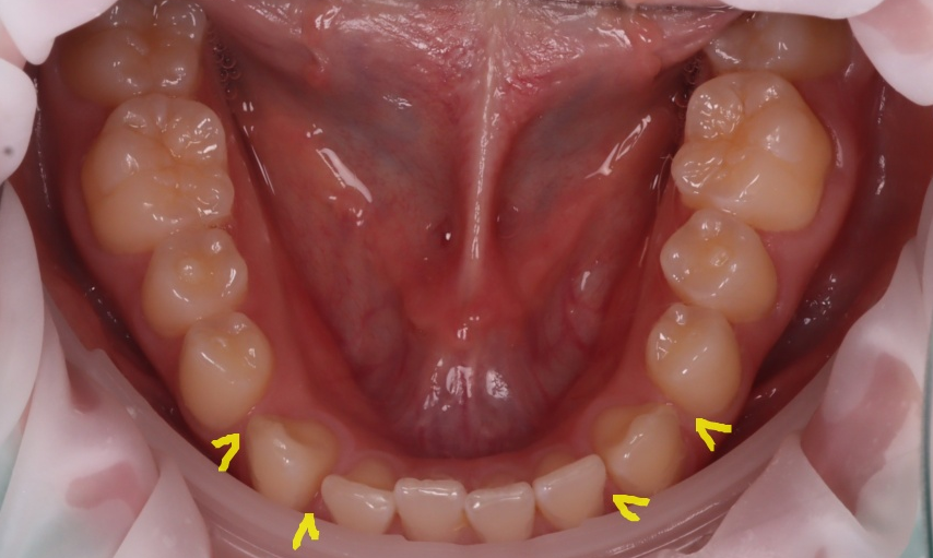 역삼역치과 벌어진 앞니 레진 이렇게 해야 진짜 티 안나요 관련 이미지 17