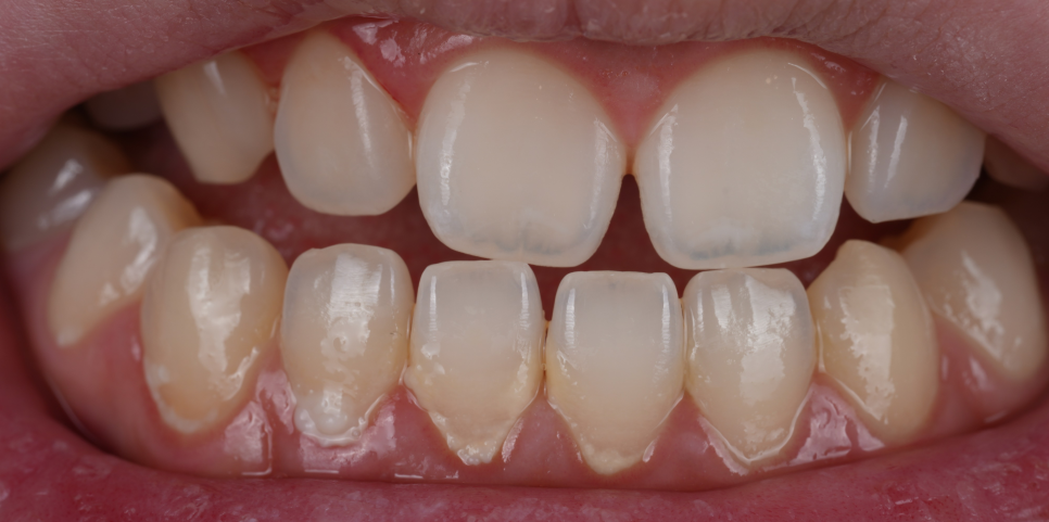 방배동치과 앞니 벌어짐 해결하러 강릉에서 오셨어요 관련 이미지 7