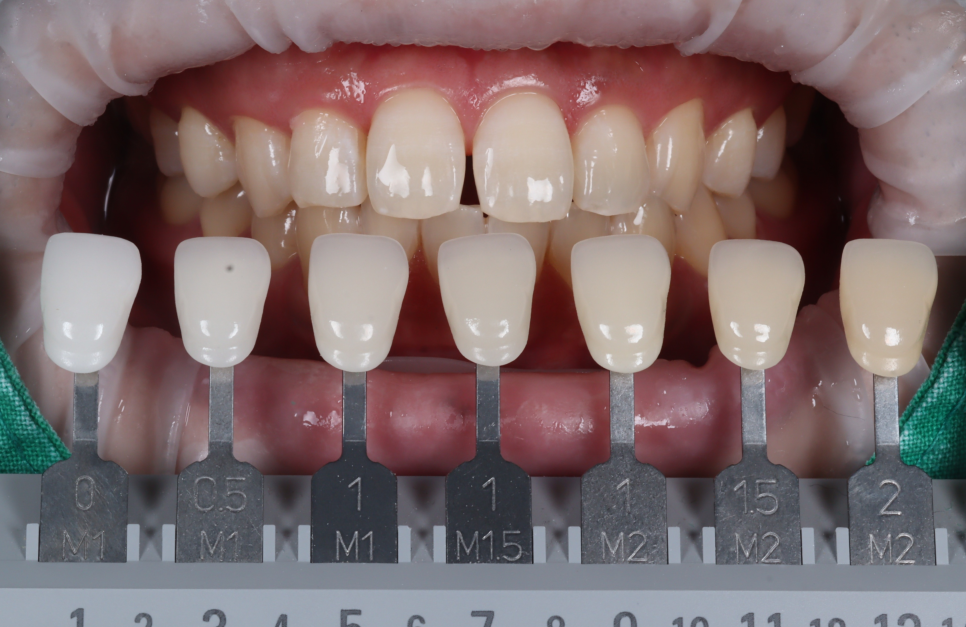 방배동치과 누렇고 벌어진 치아 미백과 레진 치료 관련 이미지 6