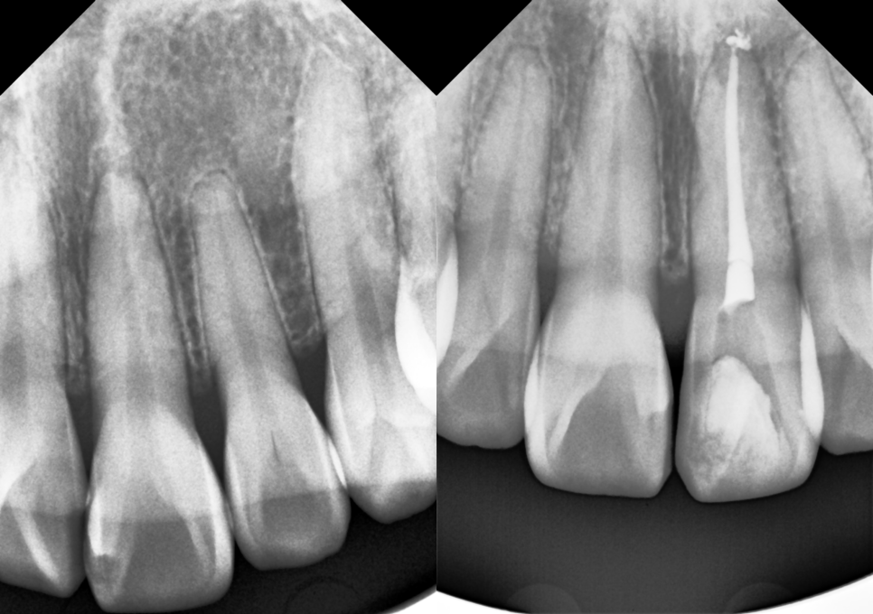 실활치 미백 과정, 크라운 없이 레진으로 마무리 해요 관련 이미지 3