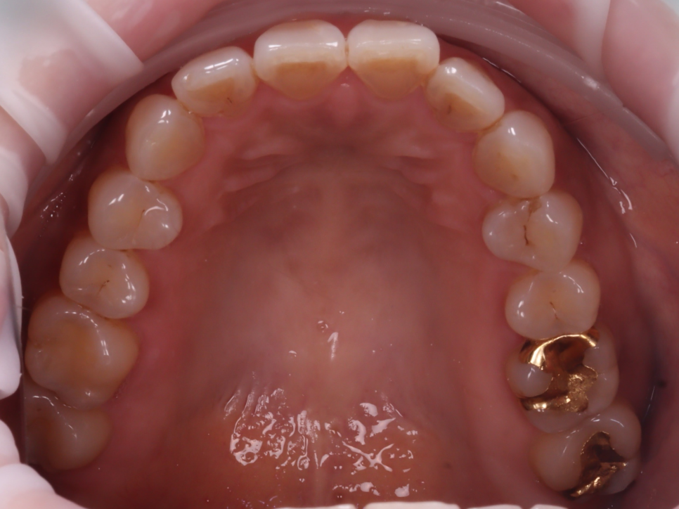 Gangnam Dental Clinic: You Wanted an Extraction, but We Preserved the Tooth with Root Canal Treatment + Overlay image 4