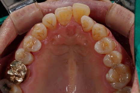 당신이 서울 교대역 재주좋은치과 라미네이트로 치료해야 하는 이유 관련 이미지 6