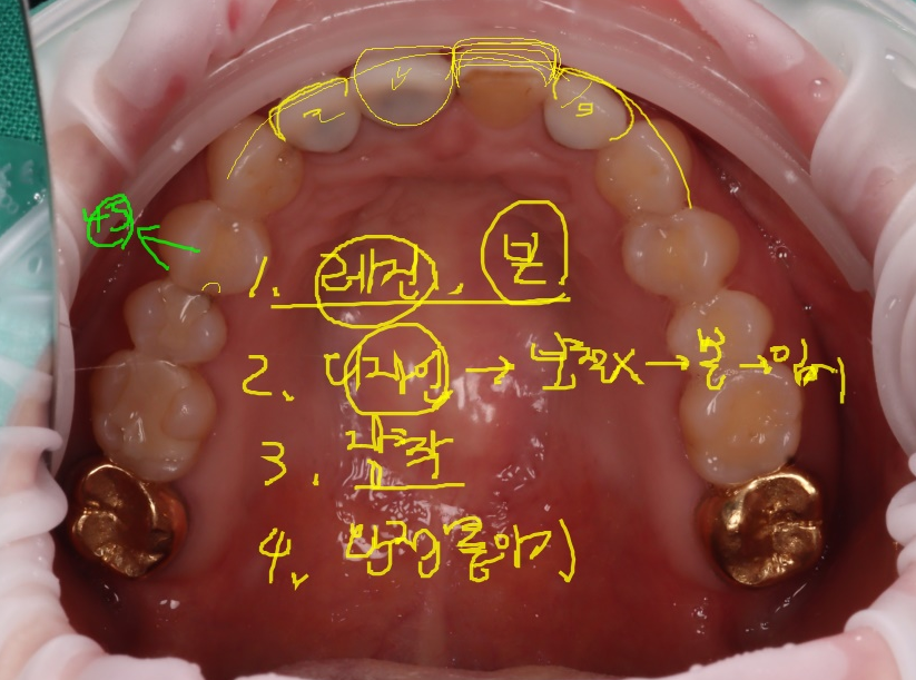 라미네이트, 크라운 재치료, 잇몸 성형까지 앞니 6개 치료 관련 이미지 4