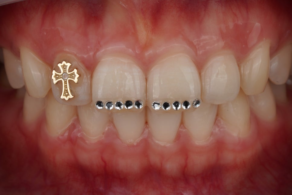 요즘 투스젬 맛집, 근데 이제 제거 맛집인- 투스젬 제거킹 재좋치 관련 이미지 6