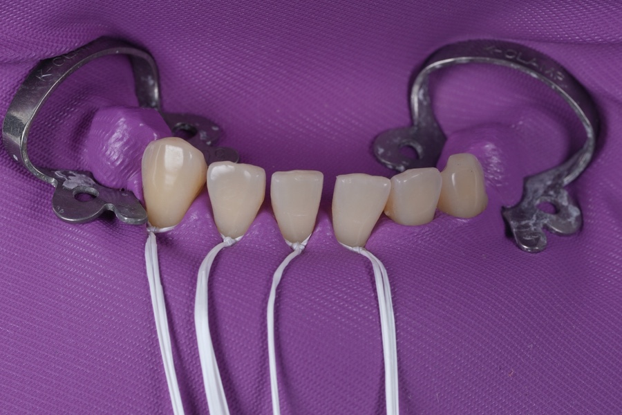 Multiple Gaps Between the Lower Front Teeth Below Gyodae Station—Filled in a Single Day image 1