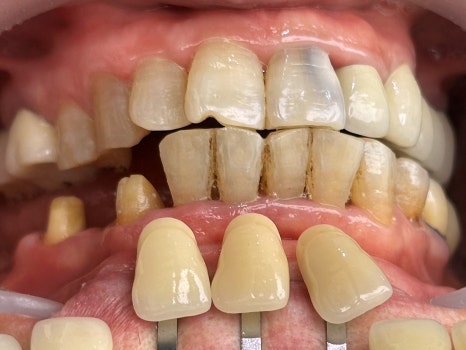 교대역 충치 치과, 신경치료 진단은 보수적으로 접근합니다. 관련 이미지 16