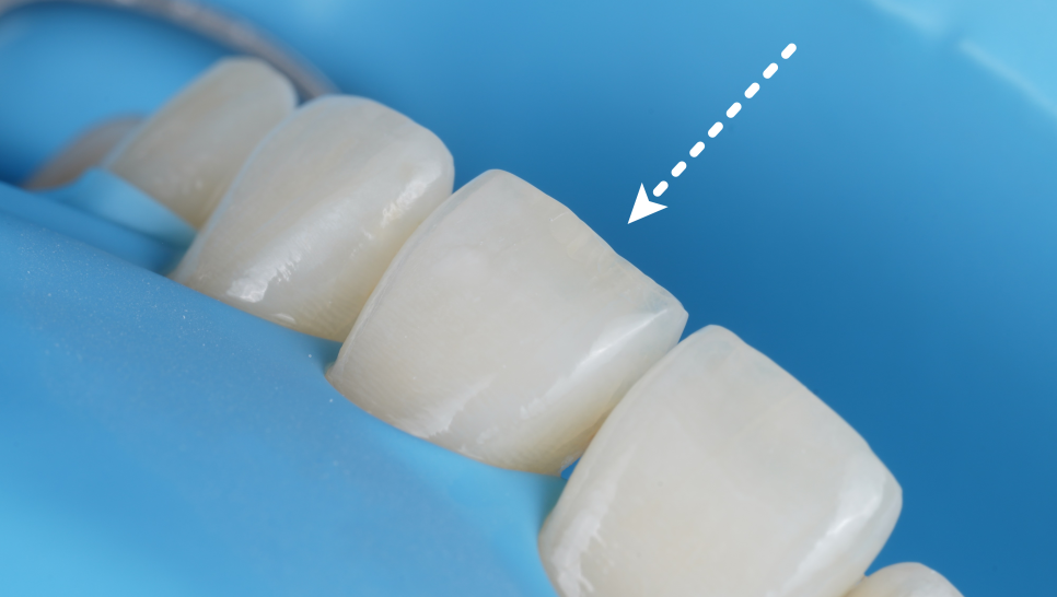 강남치과 짧아 보이는 치아 레진으로 당일 치료 관련 이미지 8