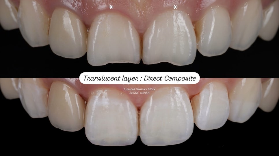 앞니 깨짐, 레진으로 감쪽같이 복원하는 방법 관련 이미지 1
