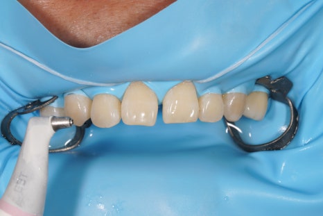 당신이 서울 교대역 재주좋은치과 라미네이트로 치료해야 하는 이유 관련 이미지 7