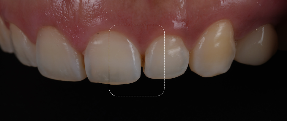 서초구치과 치아 사이 삭제 부작용과 치료법 관련 이미지 5
