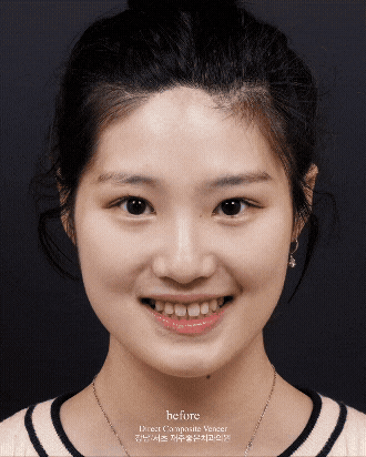 앞니 벌어짐 레진으로 삭제없이 충분히 예쁘게 할 수 있어요 관련 이미지 2