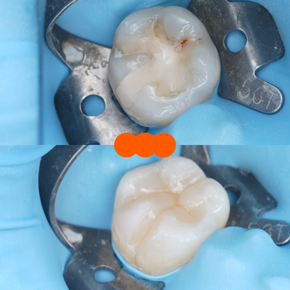 교대역치과 타치과 신경치료, 크라운 진단받았으나 레진으로 치료 관련 이미지 22