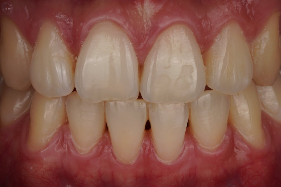 치과의사의 치아 살짝 깨짐, 레진으로 치료한 서초동 치과 관련 이미지 1