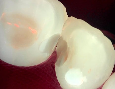 서초동치과 전라도 광주에서 레진 재치료 받으러 오신 사례 관련 이미지 9