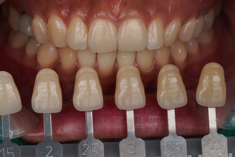 역삼동 치과는 응급실이 아니예요, 원데이 치아미백으로 만드는 환한 미소 관련 이미지 2