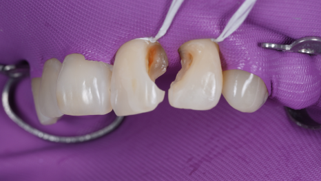 잘못된 앞니 레진 뼈까지 녹인다? 레진 재치료 과정 관련 이미지 11