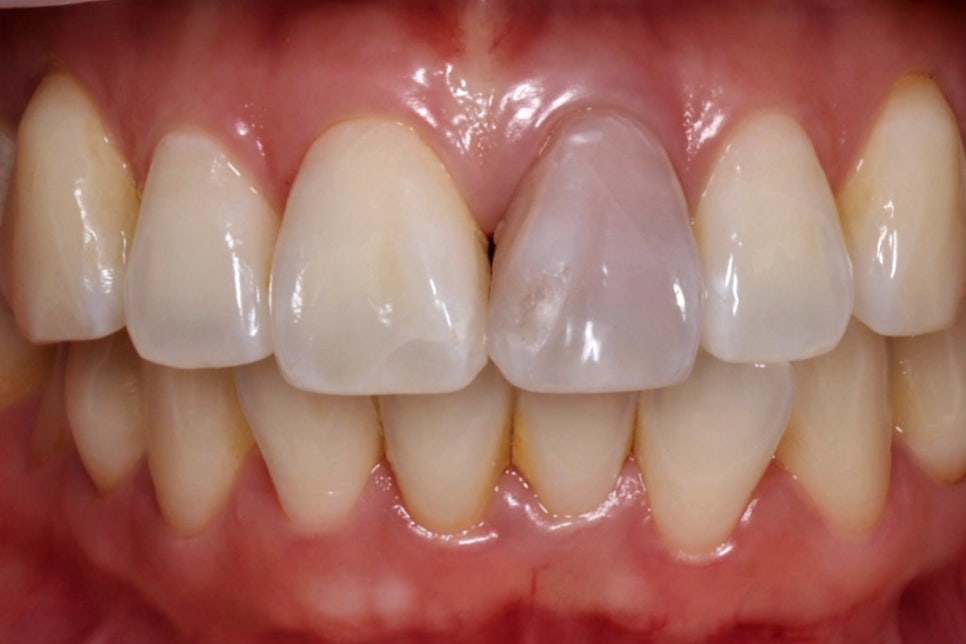 앞니 신경치료 변색 원인과 치료법인 실활치 미백 관련 이미지 12