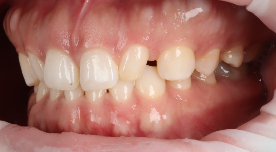 앞니 왜소치 레진 치과의사 소개로 내원해 당일 완료 관련 이미지 6