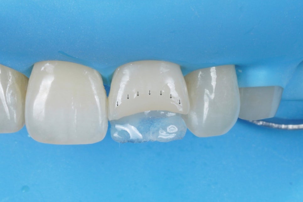 서울 앞니 레진으로 40분 안에 자연스럽게 복원한 케이스 관련 이미지 6