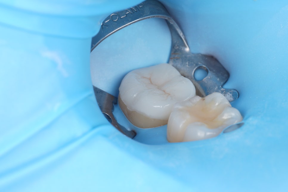 서초동치과 치아 삭제 원하지 않는다면 오버레이 하세요 관련 이미지 10