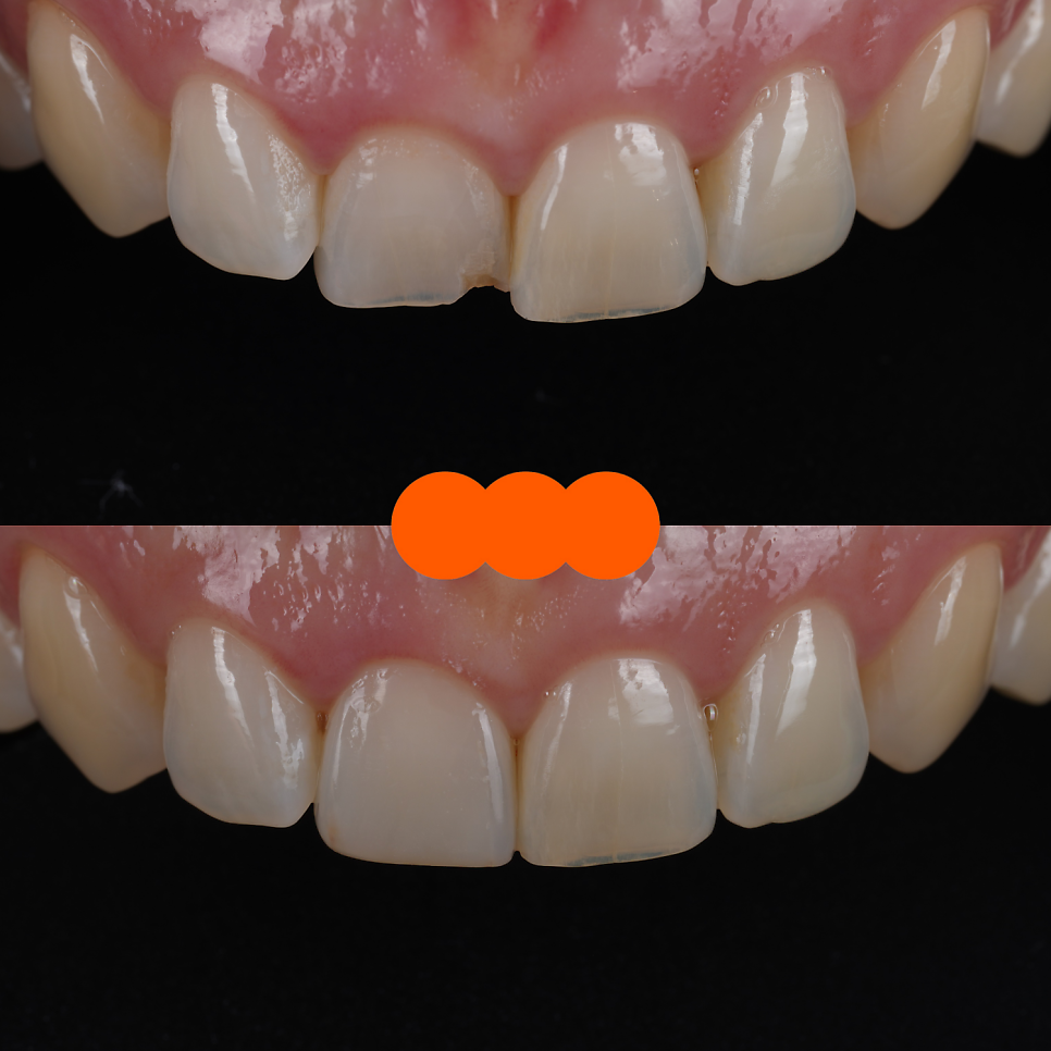 Gangnam Dental Clinic: Resin Restoration Process for a Chipped Front Tooth Considering Tooth Position image 10