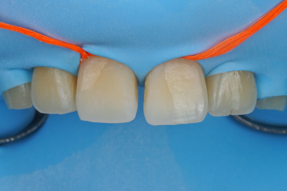 앞니 벌어짐을 레진 비니어로 당일 치료한 서초동 치과 관련 이미지 5